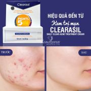 Kem trị mụn Clearasil Fights 5 Acne Maximum Strength của Mỹ