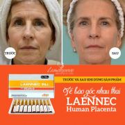 Tế bào gốc nhau thai tươi Laennec Human Placenta 50 ống