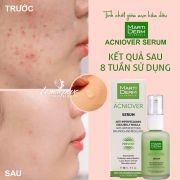 Tinh chất giảm mụn kiểm soát nhờn MartiDerm Acniover Serum